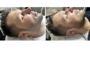 Soin-Gladiator-Avant-Apres