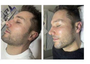 Soin-visage-hominis-avant-apres