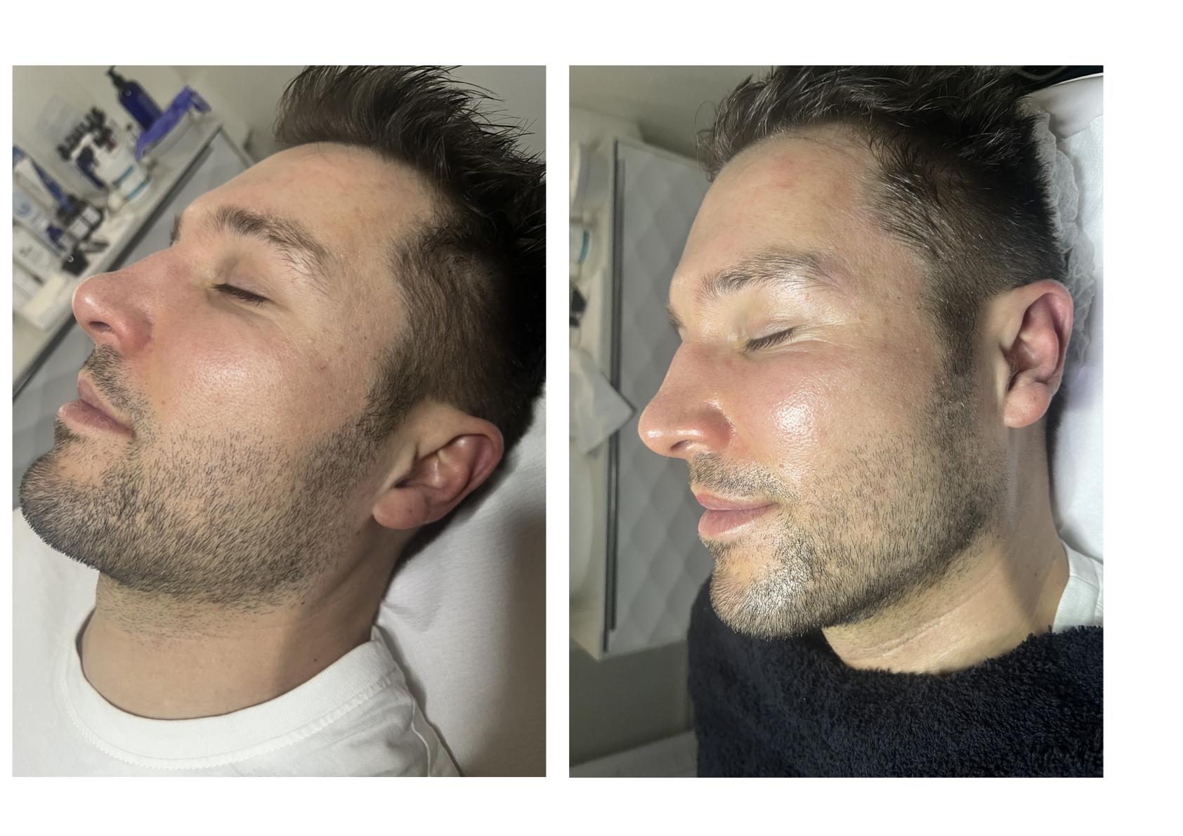 Soin-visage-hominis-avant-apres