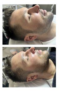 Soin-Gladiator-Avant-Apres